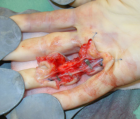 Figur 5.d
 En arterie er rekunstruert med venegraft fra underarmen.
