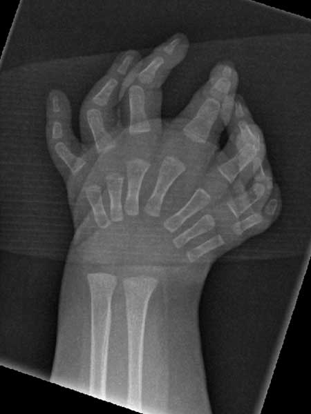 Figur 10. a. Røntgen av hånd. 