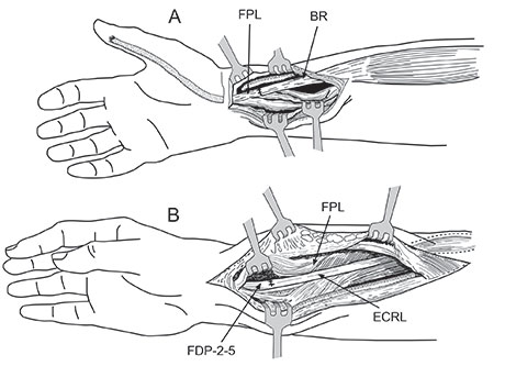 Figur 3a. M. brachioradialis skal være ny motor for tommelbøy. Den fridissikeres til høyt på underarmen, tranponeres og kobles til tommelens lange bøyesene (FPL) like proksimalt for håbdleddet. ECRL kan kobles til de dype fingerbøyerne (FDP II-V) for å gi aktiv fingerbøy.
