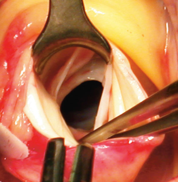 Tverrklemt, åpnet aorta. Subaortamembran synlig nedenfor aortaklaffen. Ikke mye plass å bevege seg på der!