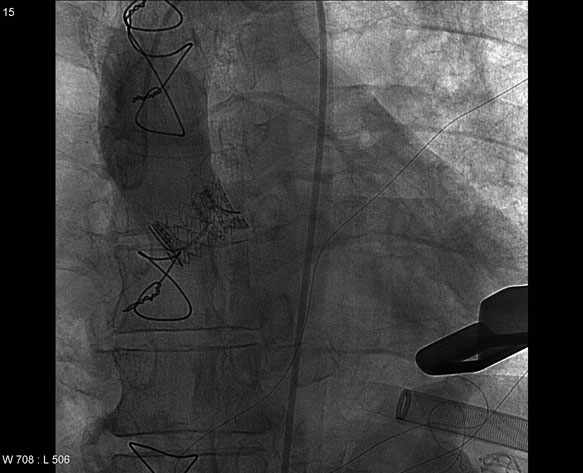 Fig. 3b. Edwards Sapien klaff i klaff implantasjon, UNN april 2010