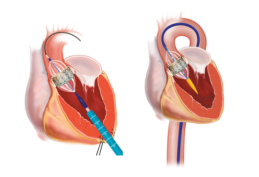 Fig. 1c. Transkateter aortaventil-implantasjon (Edwards Sapien) med transapical tilgang via minithoracotomi. Fig. 1b. Transkateter aortaventil-implantasjon (Edwards Sapien) med transfemoral tilgang.
