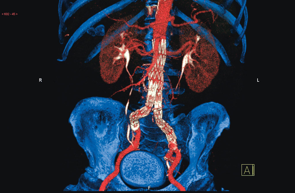 Figur 1. Stentgraft, abdominal aorta