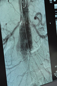 Figur 3. Deponering av stentgraftet intra-arterielt nedenfor nyrearteriene ved den proksimale abdominale aorta aneurismehals. 