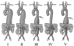 Figur 1: Crawfords klassifikasjon av TAAA, modifisert av Safi. Crawford beskrev den første TAAA klassifisering basert på anatomisk utbredelse. Type I: Involverer det meste av descendens fra subclavia til suprarenale abdominal aorta. Type II: Har størst utbredelse, går fra subclavia til aortabifurkatur. Type III: Omfatter distale descendens til aortabifurkatur. Type IV: TAAAs er begrenset til abdominalaorta under diafragma. Type V: Safi’s gruppe modifiserte klassifiseringen ved å legge til Type V, som går fra distale thorakalaorta til og med truncus celiacus og mesenterica superior, men ikke nyrearteriene.