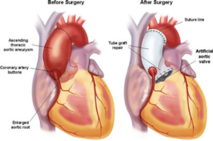 Figur 1: Operasjonsmetoder ved dilatert aortarot: 1a: Klaffebærende condiut med mekanisk aortaventil.