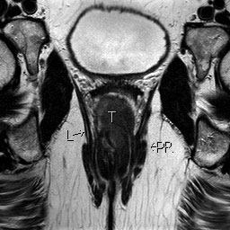 Bilde 1: Skrå Cor T2, 3mm. T: tumor i anorectalovergangen. PR: m.puborectalis. L: m.levator anii