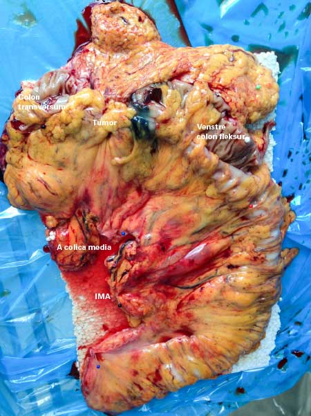 Figur 2: Preparat etter laparoskopisk CME utvidet venstresidig hemikolektomi pga ca coli i venstre colon transversum (colon sigmoideum også resisert for å få avsatt arteria mes. inferior (IMA) helt sentralt. A colica media avsatt sentralt. Disseksjon langs kurvatura major på ventrikkelen for å eksidere lymfeknuter langs a. gastroepiploica. SPOT markering distalt for tumor for å eksakt lokalisere tumor perioperativt.