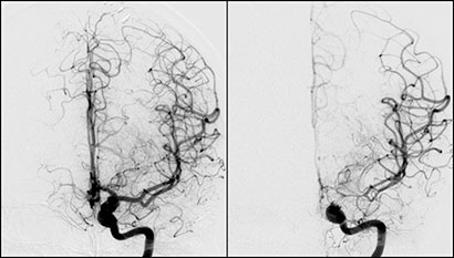 Figur 3: Samme pasient som over. Digitalt Subtraksjons Angiografi (DSA) hvor bildet til venstre er tatt umiddelbart før coiling av anuerysme i ve. carotissifong. Aneurysmet hadde blødd dagen før. Kontroll angio etter coiling viste normale kar distalt for aneurysmet. Bildet til høyre er tatt 11 dager etter SAB. Coilmaterialet kan ses delvis suprimert. Her ses uttalte karspasmer i distale a. carotis interna, A1 (a. cerebri anterior fram til ACOM) og M1 (a. cerebri media fram til bifurkaturen). Pas svarte godt på gjentatte lokale injeksjoner med Nimodipin fra a. carotis interna. I tillegg ble det gitt Nimodipin i.v. 