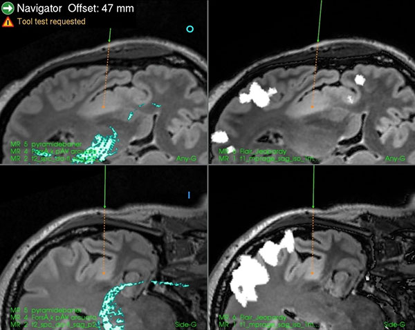 Figur 1: MR-bilde (FLAIR-sekevns) av lavgradig gliom i venstre insula-region. Bildene er importert i nevronavigasjonssystemet på operasjonsstua. Funksjonelle data er inkorporert i bildene: Pyramidebanene er blå og språkområder er hvite.