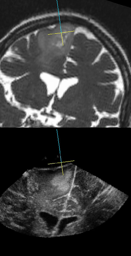 Figur 1. Skjermbildet fra navigasjonssystemet SonoWand® med preoperativ 3D MR og intraoperativ3D ultralyd. Figuren viser korresponderende utsnitt fra MR T2 (øverst) og ultralyd (nederst). 
