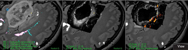 Figur 4. Et utsnitt av skjermen fra SonoWand® under en operasjon for et stort lavgradig insulagliom. Til venstre er MR flair med tractografi data. I midten er 3D ultralyd etter at store deler av svulsten er fjernet. Det lysegrå området omkring reseksjonkaviteten (sort) er restsvulst. I opptaket til høyre er alt tumorvev fjernet. I tillegg er 3D ultralyd angiografi (rødt) lagt inn.