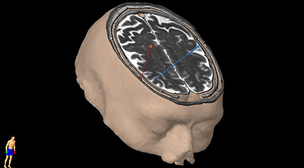 Figur 6. Planlagte trajektorier for innsetting av elektroder på grunnlag av pasientene aktuelle MR us og nevronavigasjonsserie.