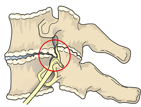 Figur 3: Skjematisk fremstilling av spondylotiske forandringer i nakken som har resultert i trang rotkanal og radikulopati.