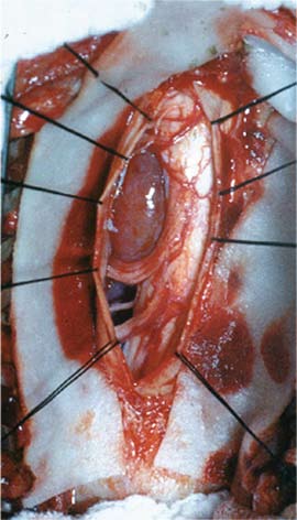 Bilde 1: Dura holdes til side med suturer. Meningiomet presser ryggmargen mot høyre.