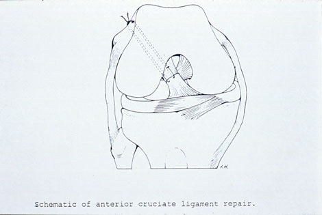 Figur 2. ACL sutur.