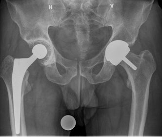Bilde 2: Røntgen bekken. Standard protese i høyre hofte, MoM-resurfacing i venstre.