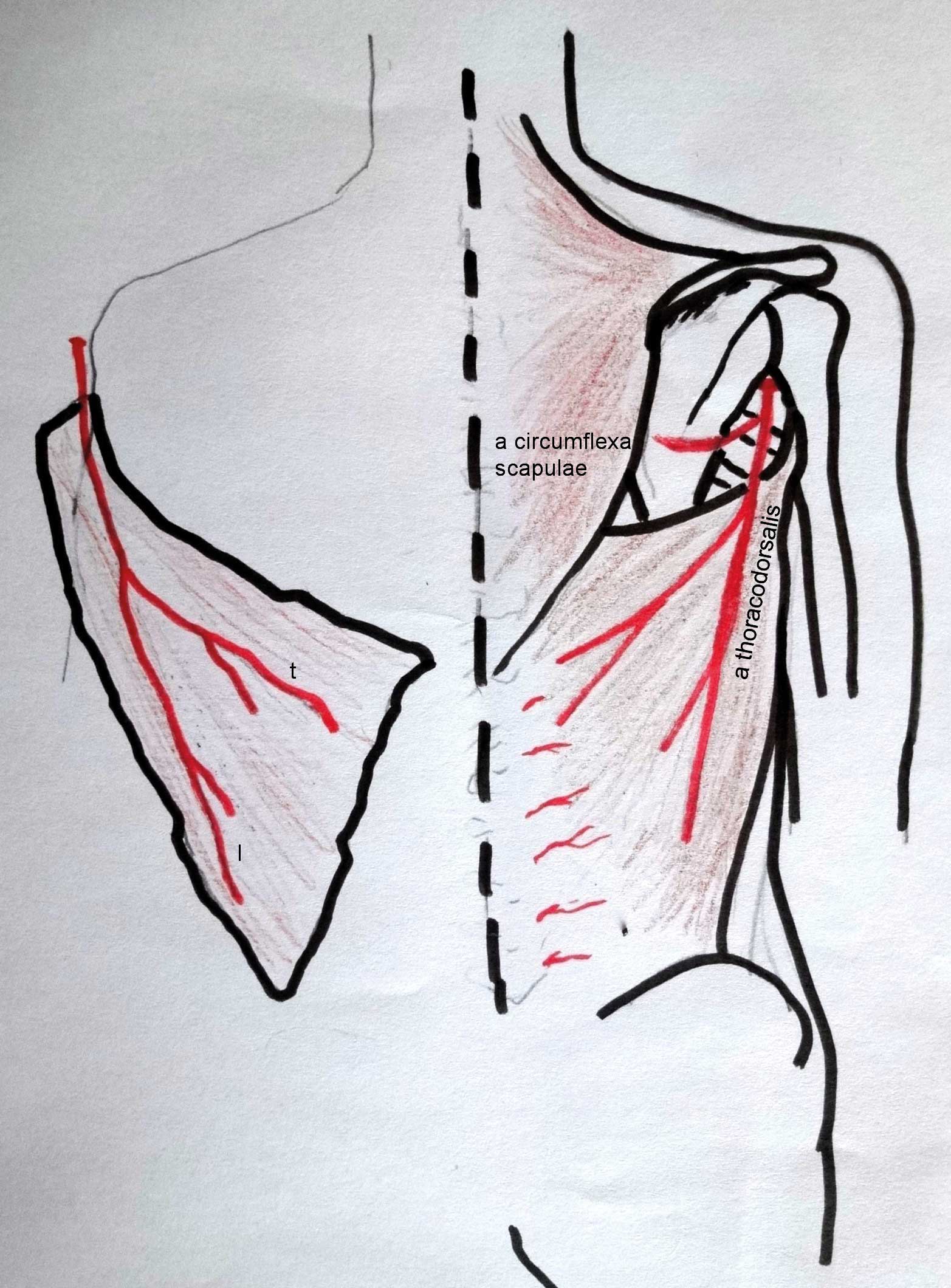 Figur 3. M. latissimus dorsi er mye brukt både som stilket og fri lapp. Den forsynes proximalt av a. thoracodorsalis går av fra a. subscapularis. Denne blodforsyningen kan forsyne hele muskelen, som kan løsnes både fra humerusfestet og fra ryggtaggene og crista. Stilket på arterien kan muskelen dreies til store deler av overekstremitet og thorax. Som fri lapp gir latissimus stort areal. Muskelen kan også deles på langs da a. thoracodorsalis deler seg i en lateral (l) og en transversal (t) del.