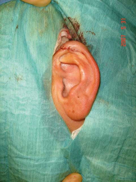 Cup-ear. Etter operasjon.