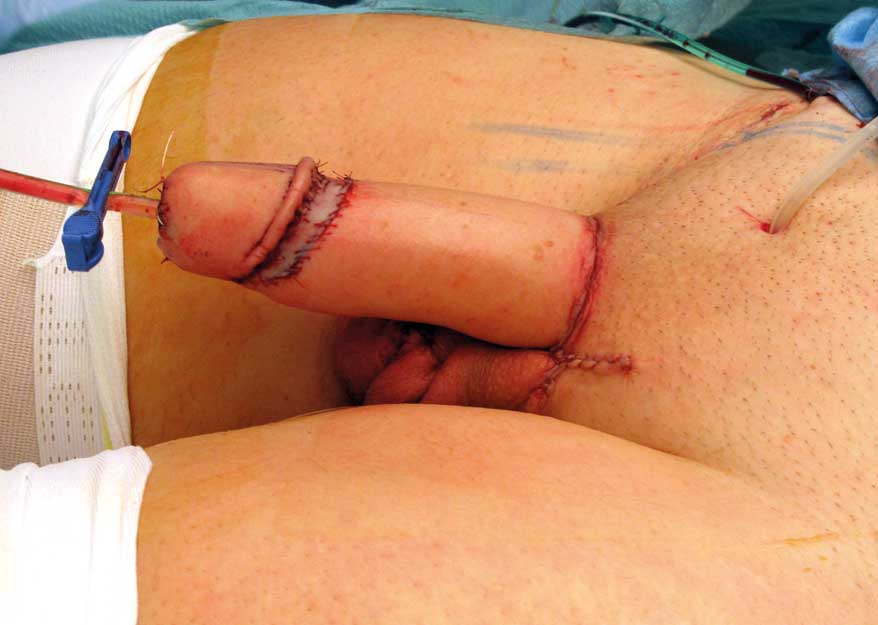 Figur 3. Umiddelbart postoperativt resultat etter falloplastikk mikrovaskulær hudlapp fra underarm (radialis lapp). I dette tilfellet er urethra rekonstruert. Foto: Kim Alexander Tønseth.