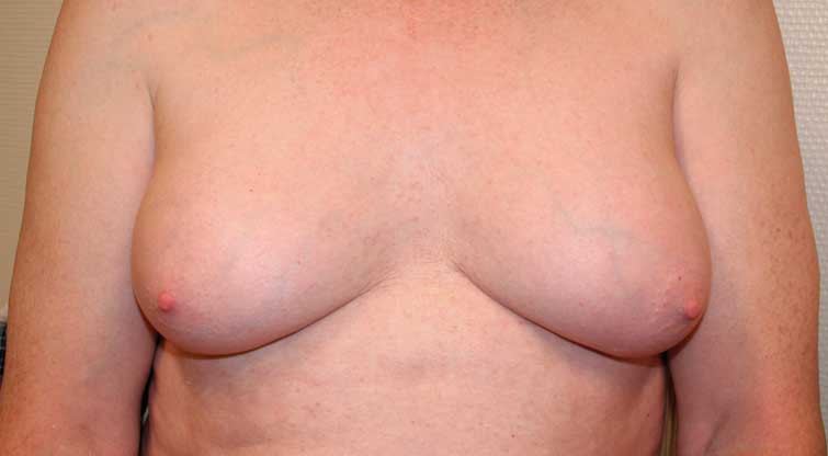 Figur 1. Klassifisering av gynekomasti a.m. Cordova. Grad 3: Hypertrofi av hele brystet, moderat hudoverskudd, areola er i samme høyde eller mindre enn 1 cm under submammærfuren. 