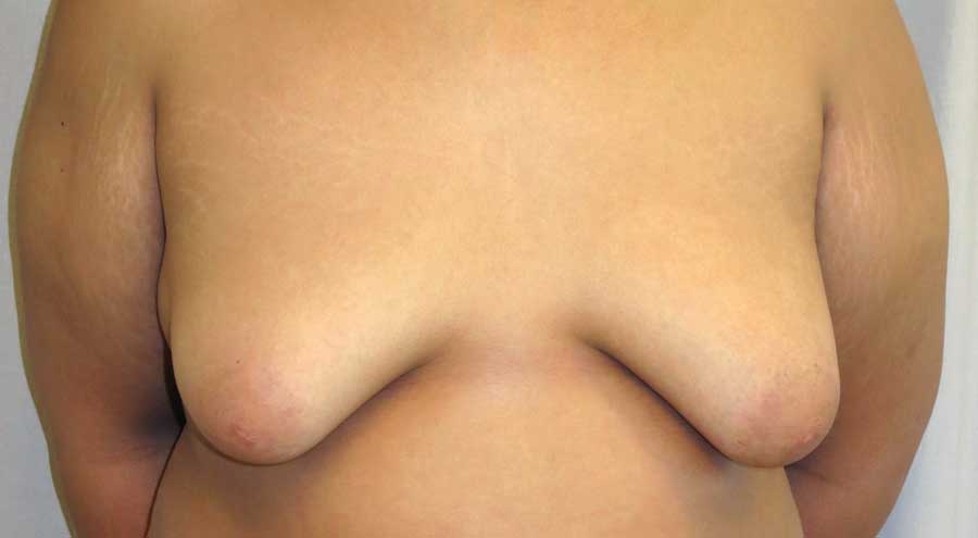 Figur 1. Klassifisering av gynekomasti a.m. Cordova. Grad 4: Hypertrofi av hele brystet, uttalt hudoverskudd, areola er mer enn 1 cm under submammærfuren. 