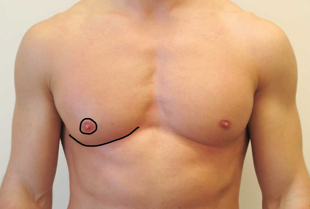 Figur 2. De svarte linjene markerer ”de estetiske linjene” i en manns brystkasse. Arr utenfor dette, særlig ut i fra areolakanten blir som regel mindre akseptert. Legg også merke til den lave plasseringen av areola i forhold til submammærfuren.