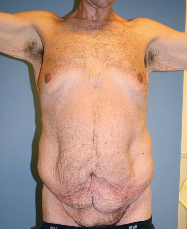 Bilde 1a. Preoperativt fotografi av 40 år gammel mann med 70 kg vekttap. Hudoverskudd både vertikalt og horisontalt med mons ptose.