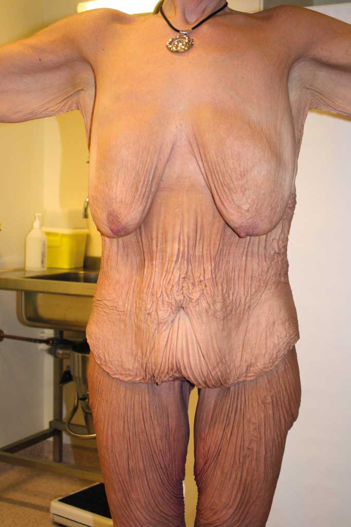 Bilde 2a og 2b. Preoperative fotografier av 39 år gammel kvinne med 70 kg vekttap. Betydelig hudoverskudd med behov for helkroppsreformering. 