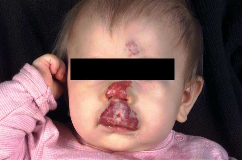 Bilde 1. 10 måneder gammel jente med infantilt hemangiom.