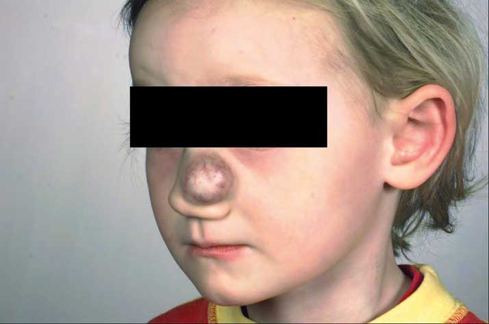 Bilde 2. 4 år gammel jente med infantilt hemangiom på nesen.