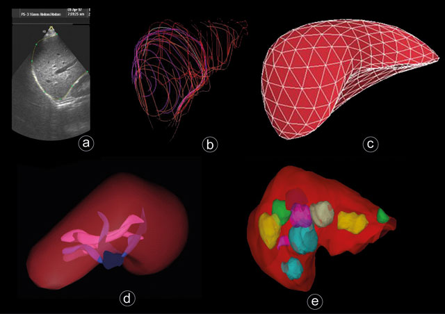Figur 3: Ultralydbilder av leveren. a) viser tradisjonelt 2D(B-mode)-scan hvor leverkanten har blitt skissert. Denne type skissering kan brukes for å danne en 3D-rekonstruksjon (segmentering) av leveren som vist i b). c) viser overflatemodell til en lever i 3D. d) viser en 3D-visning av blodkar i lever hilum/hilus. e) viser svulster i leveren i 3D.