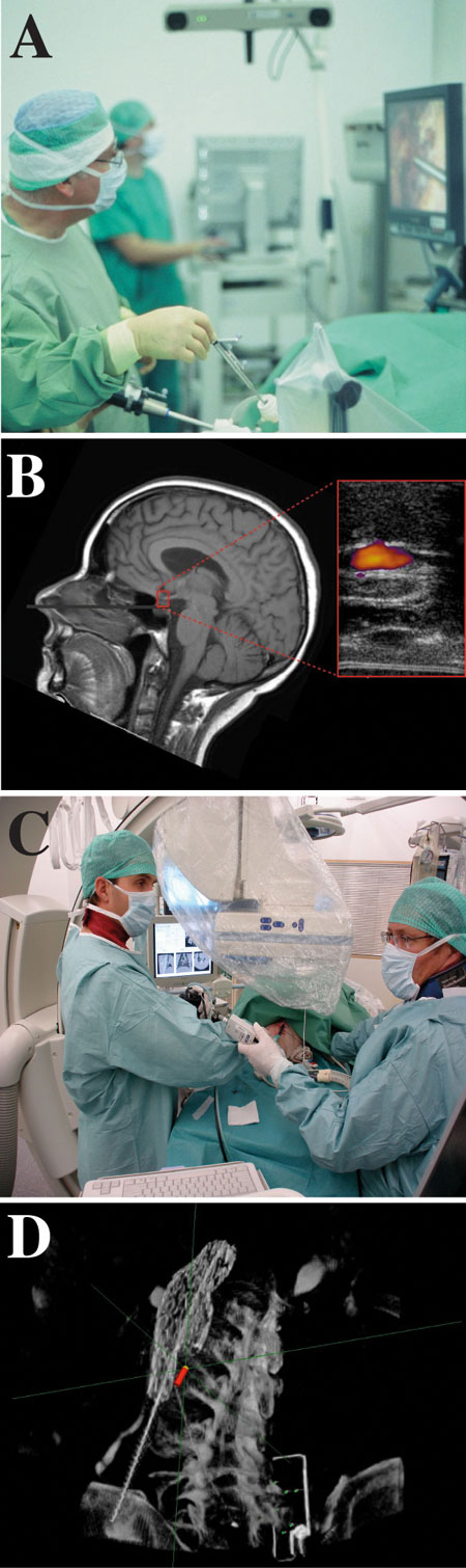 Figur 5: Kliniske applikasjoner. A) Laparoskopisk navigasjon (optisk sporing). B) Nevrokirurgisk reseksjon av en hypofysesvulst. C) Lunge navigasjon i forbindelse med griseforsøk (magnetisk sporing). D) Endovaskulær navigasjon i forbindelse med kateterinnsetting.