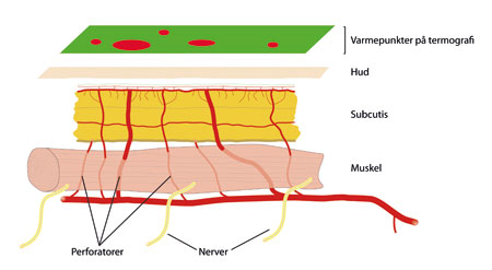 Figur 2: Perforatorer passerer gjennom muskelen på vei til det subdermale pleksus og gir varmepunkter som er synlige på termografi.