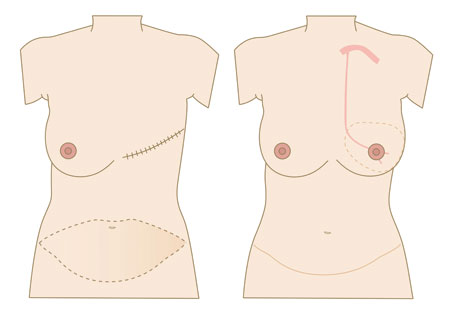 Figur 3: Ved DIEP brystrekonstruksjon flyttes hud og fett fra magen til brystveggen hvor blodforsyningen blir gjenopprettet.