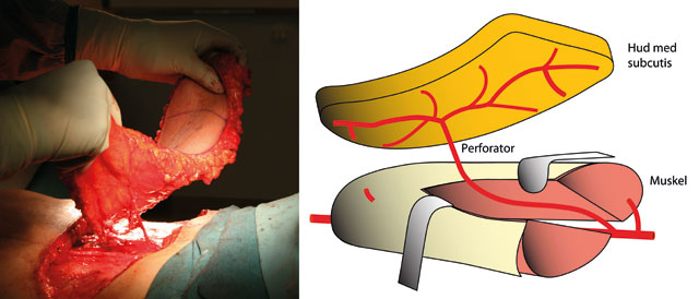 Figur 4: DIEP-lappen er basert på en perforator som kommer fra arteria og vena epigastrica inferior profunda.