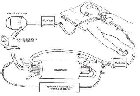 Figur 2. Skjematisk ECMO-oppsett.