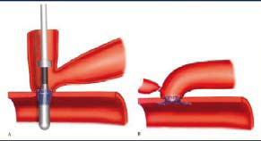 Figur 1. Eksempel på distal anastomose device