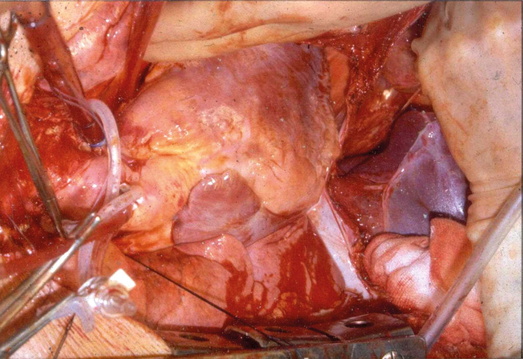 Figur 3. Kanyler i aorta og a pulmonalis for nedkjøling av thoraksorganer.
