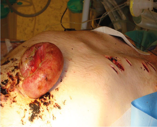 Bilde 3. Åpenbar laparotomiindikasjon: Penetrerende abdominalskade med prolaberende tynntarmslynge. Thoraxskadene ble revidert og drensbehandlet. 