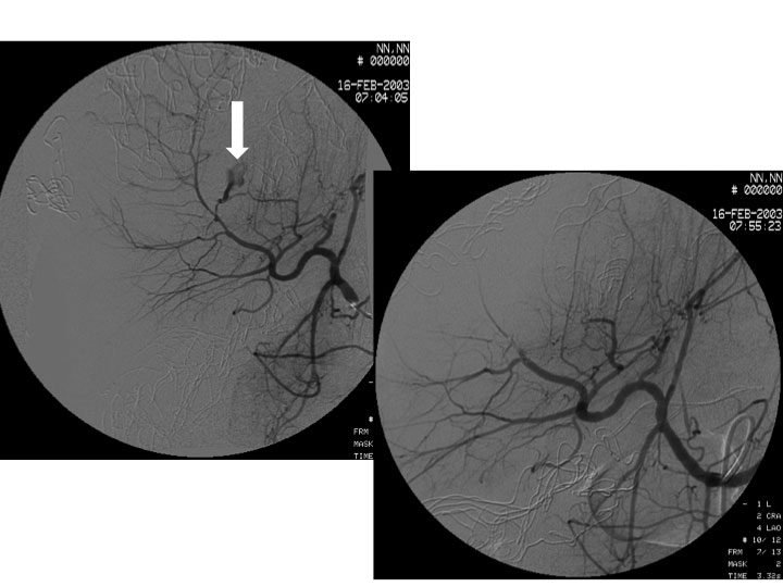 Bilde 5. Postoperativ angiografi hos pasient med leverskade behandlet med pakking som ledd i «Damage Control Resuscitation», viser pågående arteriell blødning (merket med pil på bildet til venstre). Bildet til høyre viser opphevet blødning etter selektiv embolisering. 