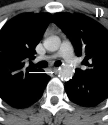 D) CT angiografi etter 6 måneder. Komplett tilbakegang av aneurysme og hematom. Pil indikerer stentgraft i aorta descendens.