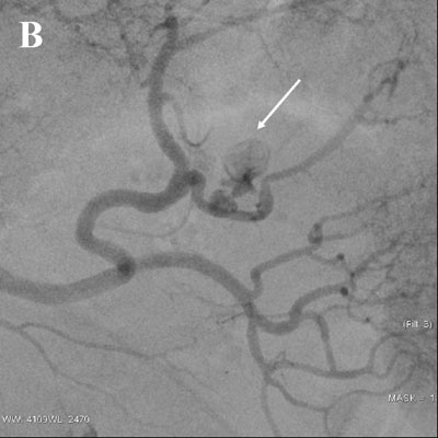 Fig. 3. B) Angiografi av arteria lienalis viser pågående blødning sentralt i miltparenchymet (pil). 