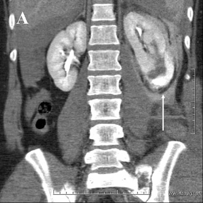 Fig. 4. Trafikkulykke, mann, 26 år. A) Ved CT ses nyreskade grad IV med stort hematom og ekstravasering caudalt (pil). 