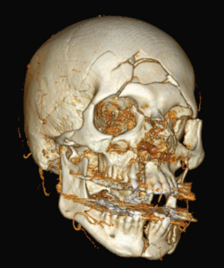 Fig. 1. Tredimensjonalt CT bilde av pasient med multiple ansiktsfrakturer.