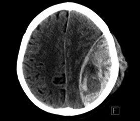 Figur 1. Aksialt CT-snitt. Stort venstresidig epiduralt hematom med lavattenuerende områder («swirl sign») som indikerer pågående blødning.