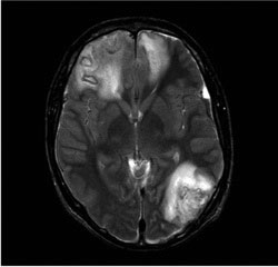 Figur 3. Aksialt T2-snitt. Kontusjonsforandringer med hemorragiske innslag i begger frontallapper og venstre occipitallapp.