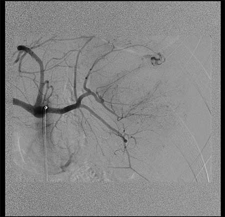 Figur 2. Coronalt angiografi bilde av samme miltskade med pågående blødning/ekstravasering.