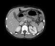 Figur 3: CT-undersøkelse av 7 år gammel pike som viser pancreastranseksjon (grad 3) som ble behandlet med pankreashalereseksjon med miltpreservasjon.