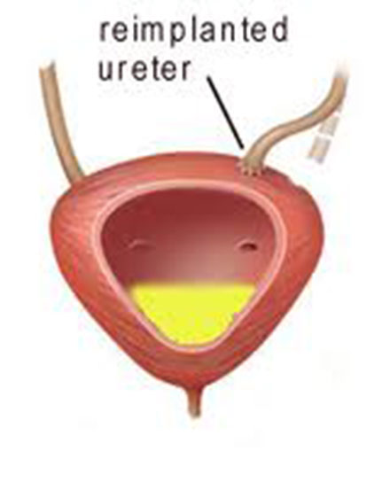 Fig. 3 Reimplantasjon av ureter.